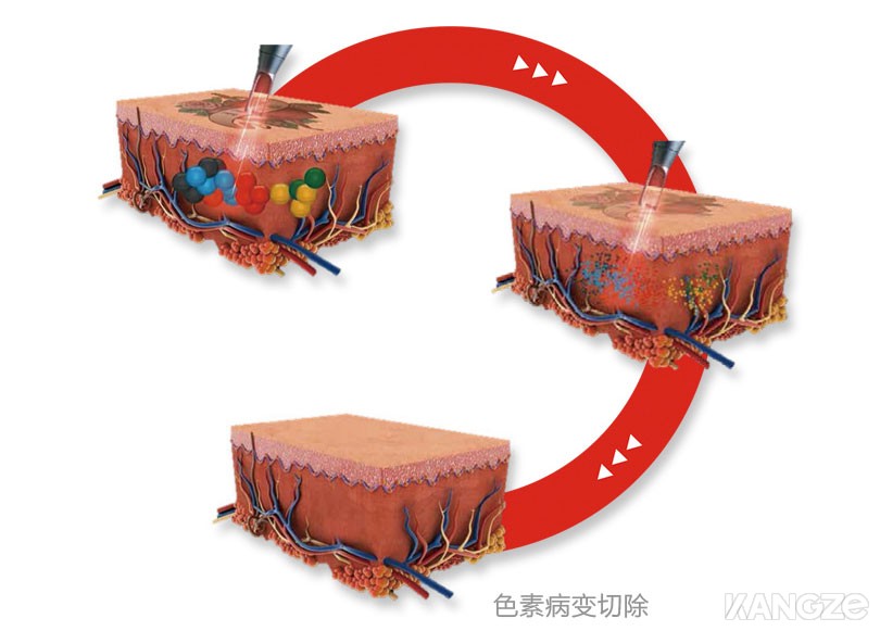 Picocare皮秒激光美容仪工作原理